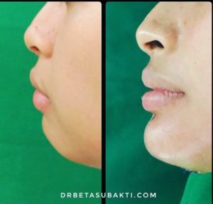 Before and after Chin Implant