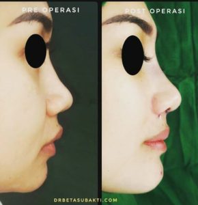 Before and after Chin Implant